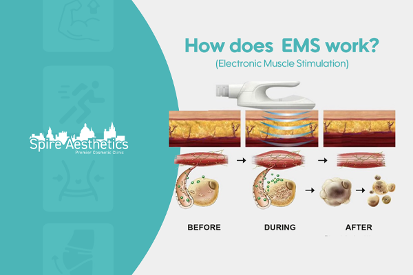 EMS treatment for post pregnancy weight loss treatment Northampton