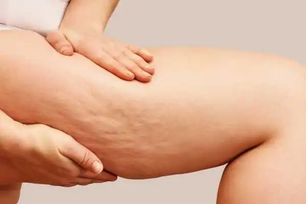 Image of woman showing leg with cellulite Northampton