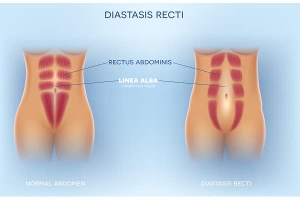 What Non-Surgical Options Are Available for Diastasis Recti Northampton?