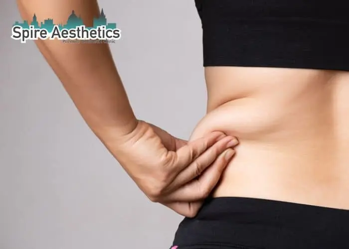 Image of woman pinching fat on their hips Northampton. Fat Freezing treatment