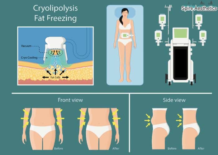Image of diet and fat freezing combined for best results for Spire Aesthetics Northampton