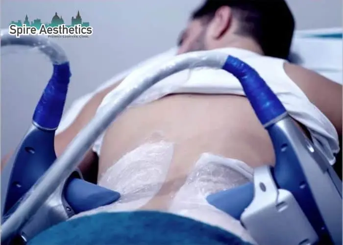 Man having fat freezing treatment done on love handles before a competitions Northampton to create a sculpted look.