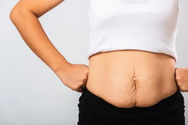Image of a woman's stomach after weight loss with sagging skin following a gastric band Northampton