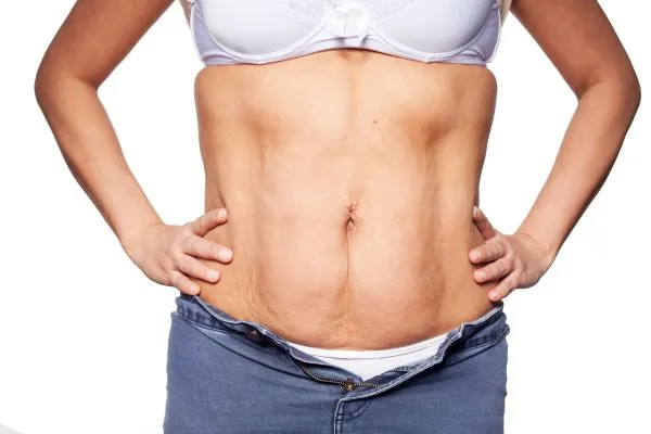 sagging skin on woman's stomach after weight loss injections Northampton
