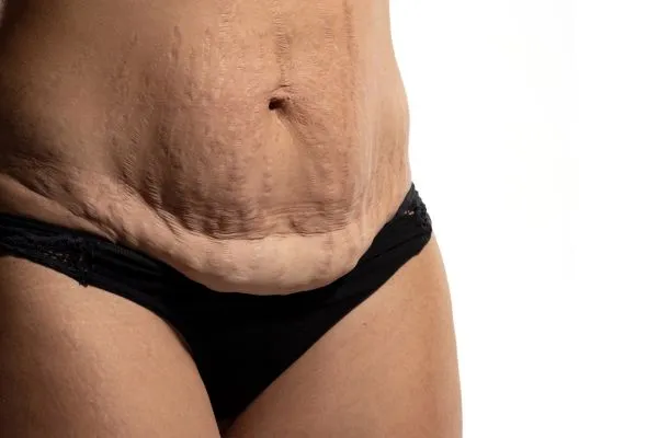 Image of womans stomach after weight loss injections Northampton showing saggy skin