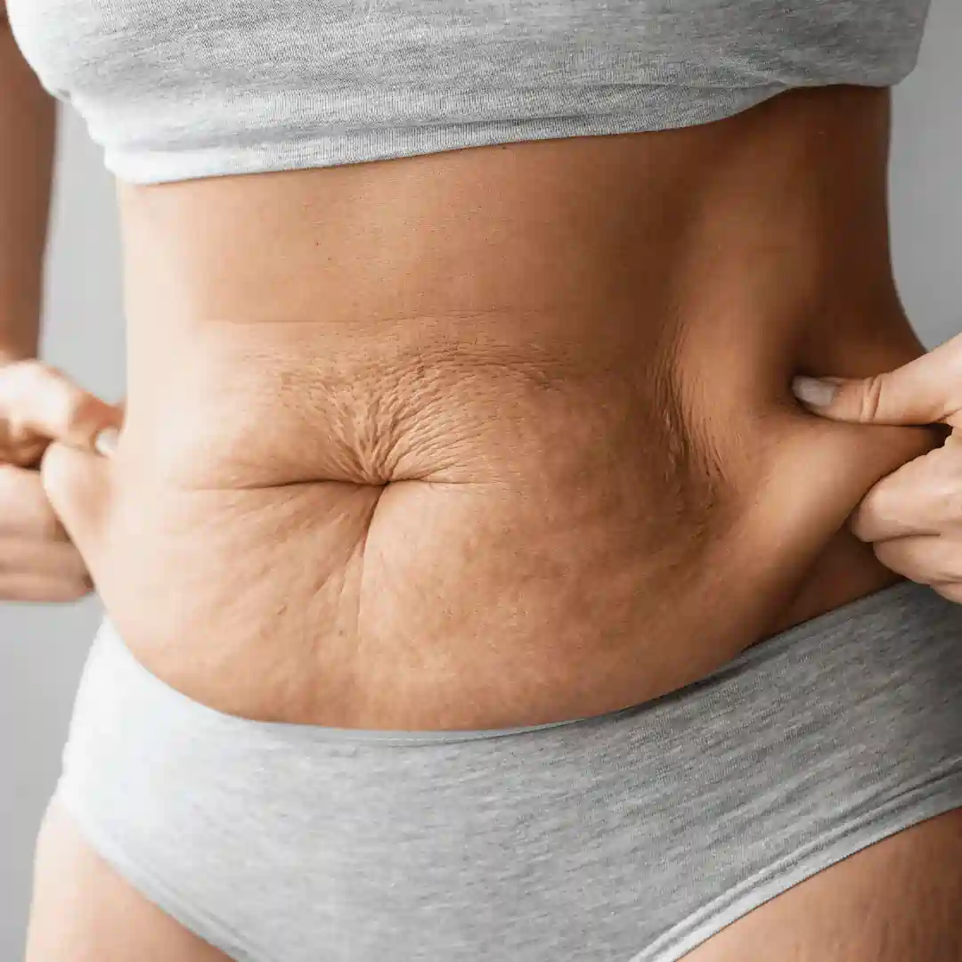 Is It Normal to Have Loose Skin After Pregnancy Northampton?