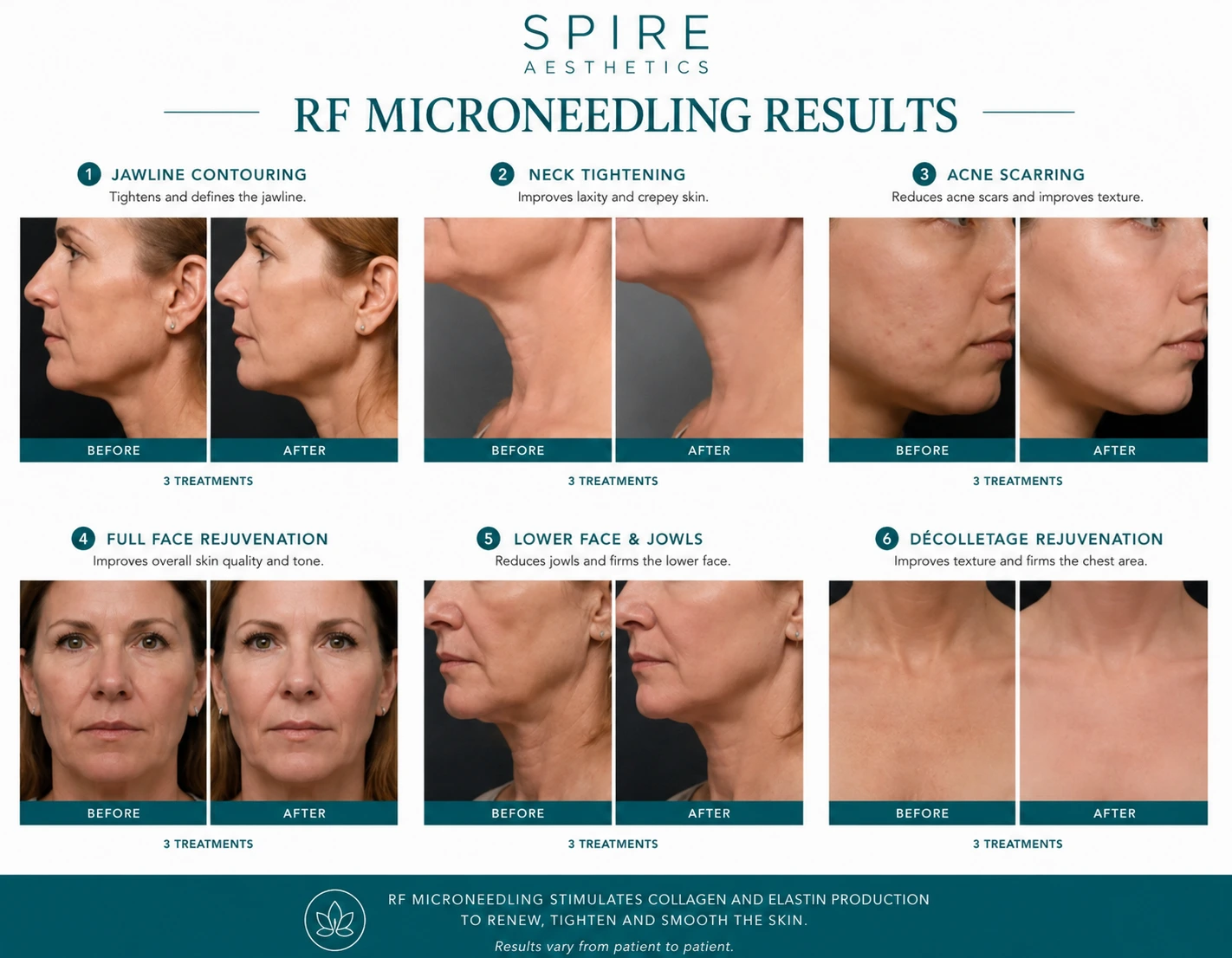 RF Microneedling Skin tightening Northampton results