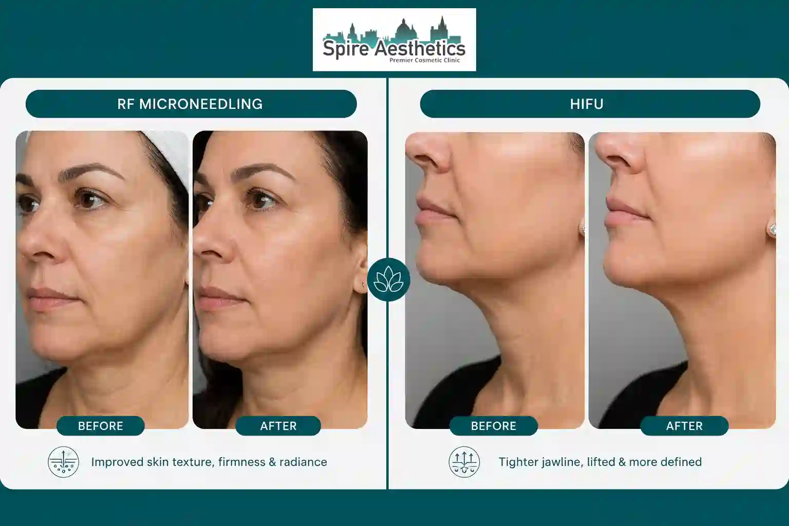 Can RF Microneedling and HIFU Be Combined Northampton?