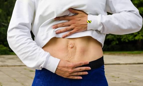 When Could Diastasis Recti Be the Missing Piece of the Puzzle Northampton?