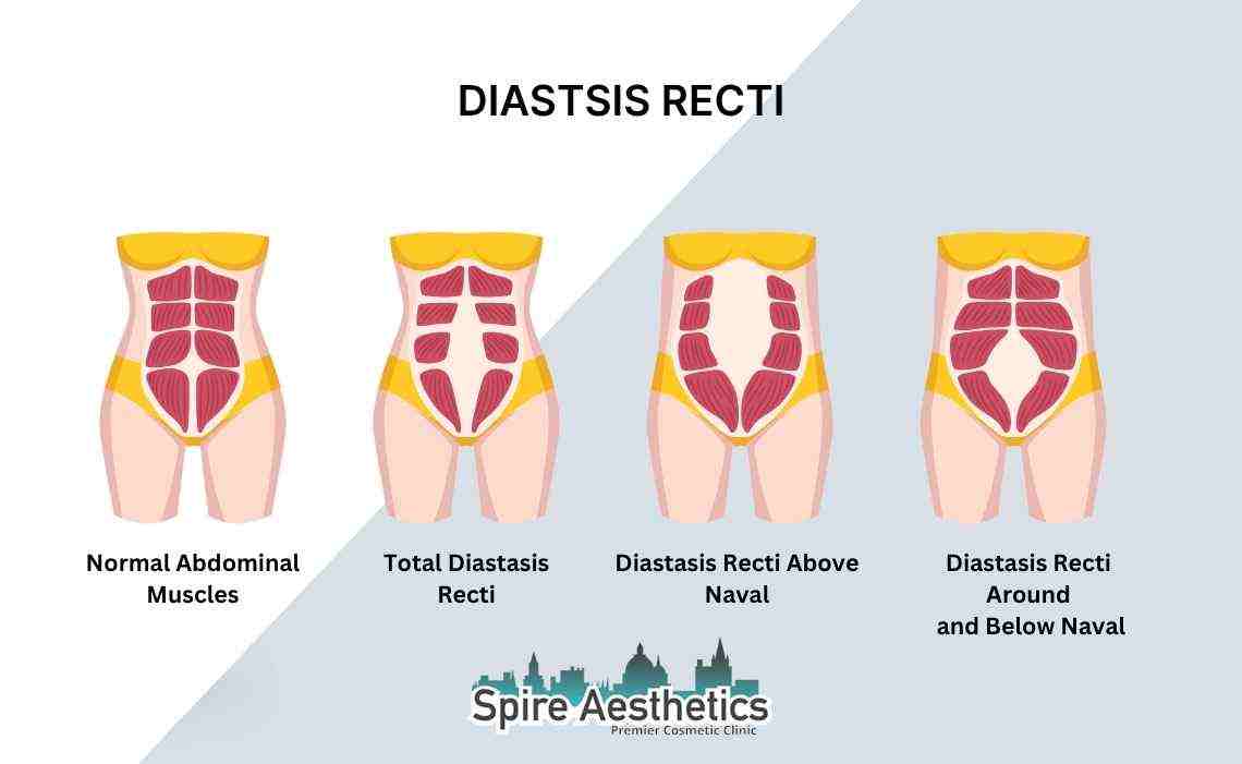 Is Non-Surgical Diastasis Recti Treatment Right for You? Common Concerns Answered Northampton